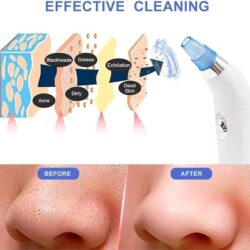 vacuum blackhead