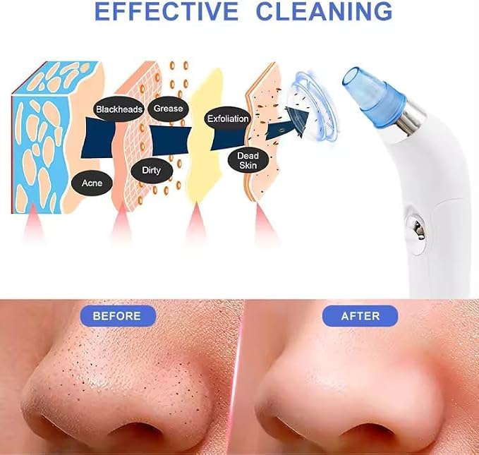 vacuum blackhead